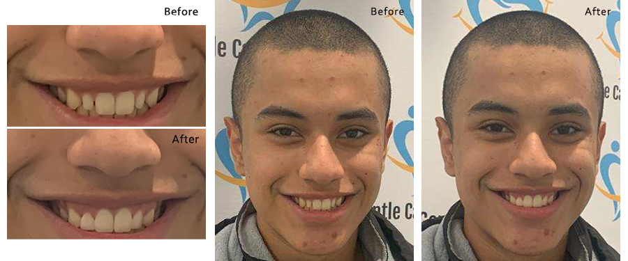 Before and After Dental Treatment Images at Gentle Care Dentistry