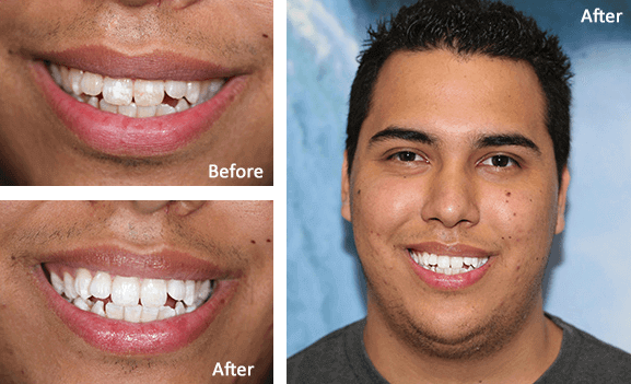 Before and After Dental Treatment Images at Gentle Care Dentistry