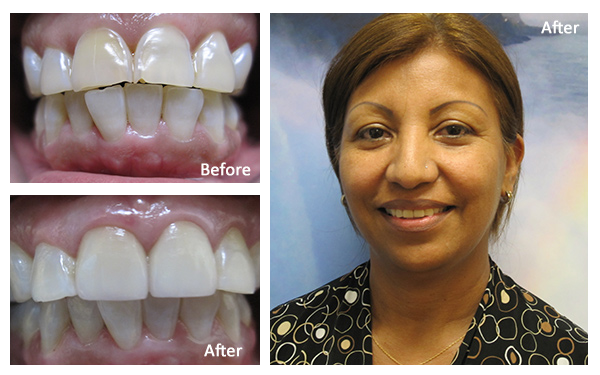Veneers Before and After