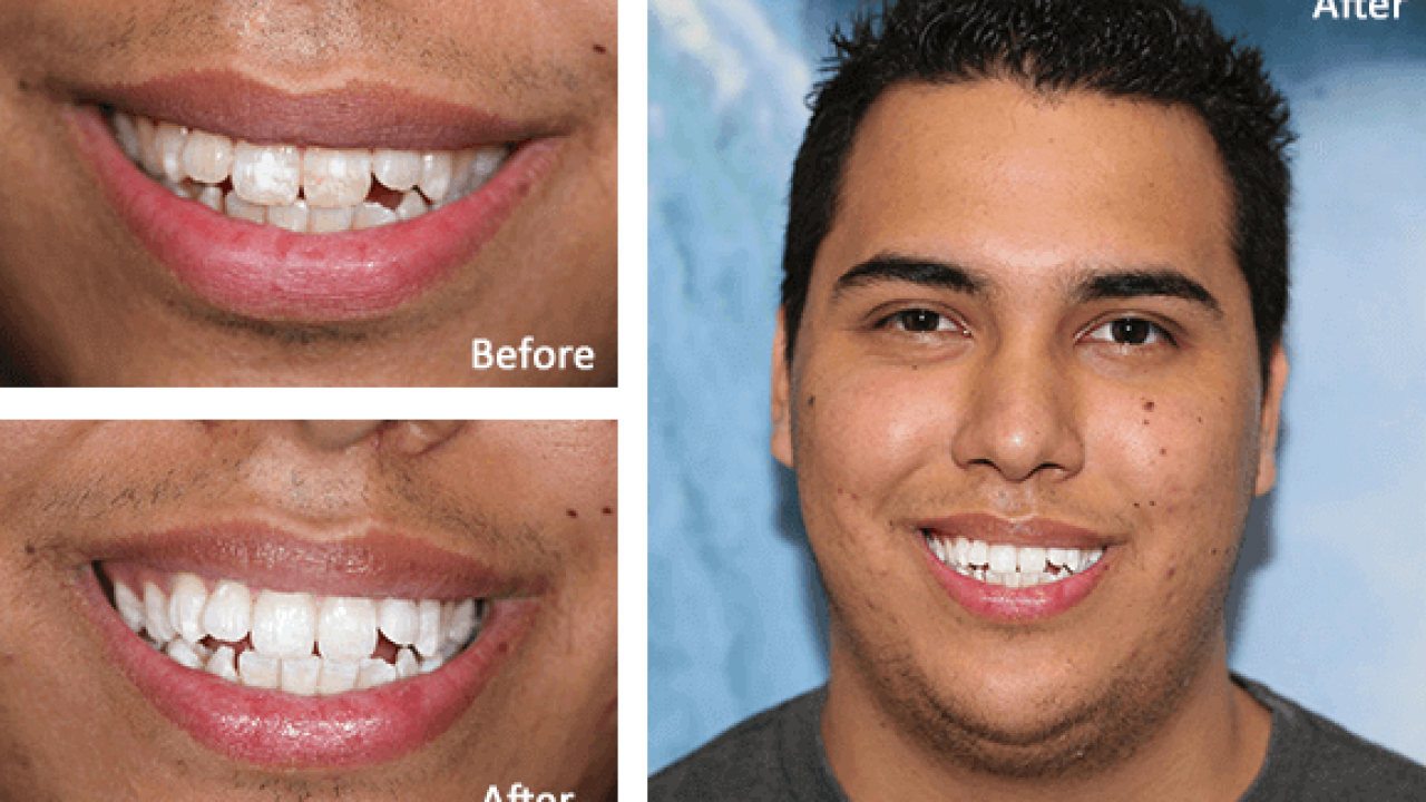 Teeth Whitening Azusa Dental Bleaching