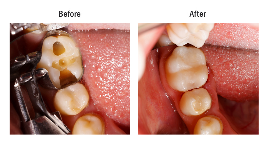 Composite or Tooth Colored Fillings Azusa