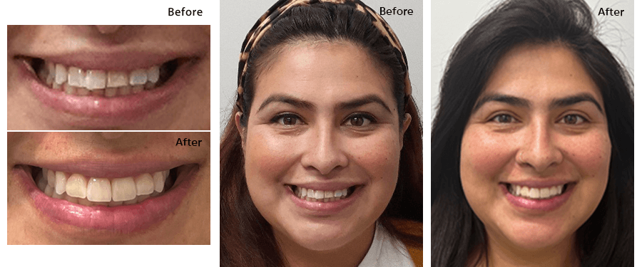 Sallie Rodriguez's Invisalign procedure - Before and After Dental Treatment Images at Gentle Care Dentistry