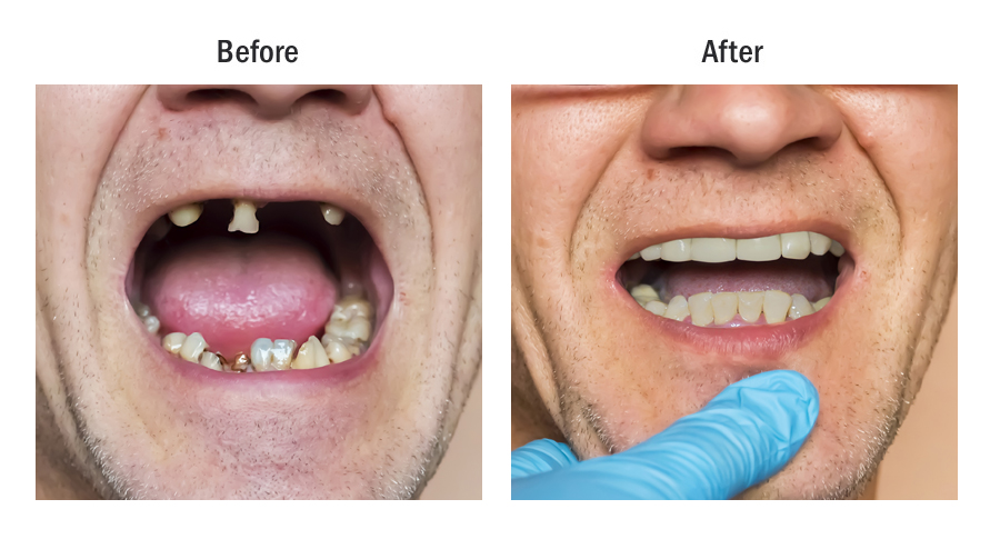 Dental Bridges before and after results Azusa CA