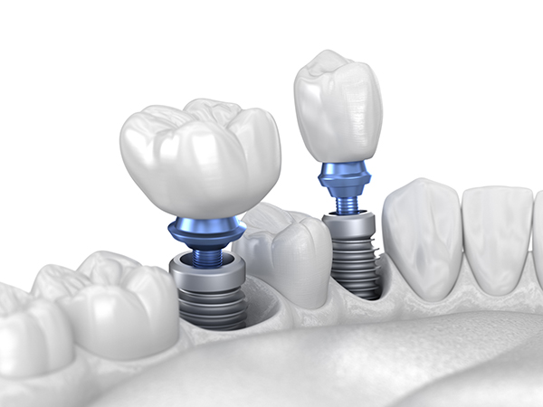 Dental Implants Azusa CA