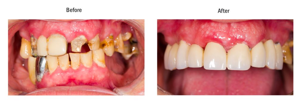 Removable Partials and Dentures Azusa CA