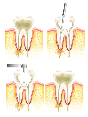 Root Canal Therapy Azusa CA