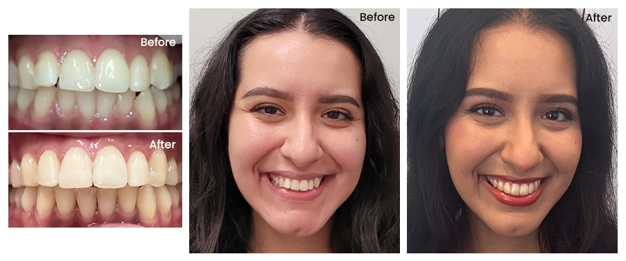 Jacqueline's Clear Aligner procedure - Before and After Dental Treatment Images at Gentle Care Dentistry